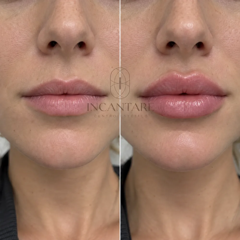 Antes e depois do preenchimento labial — exemplo 1