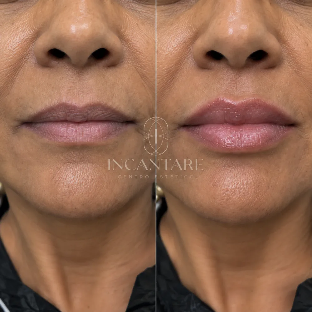 Antes e depois do preenchimento labial — exemplo 5